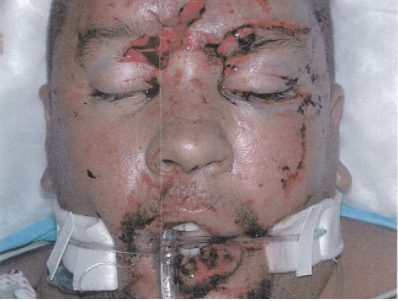 Scott in a hospital bed after the crash, his face cut and swollen, with a breathing tube and neck brace